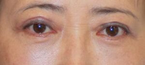 3 months after upper and lower blepharoplasty + fat injections into lower eyelids