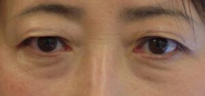 Before upper and lower blepharoplasty + fat injections into lower eyelids