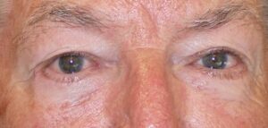 2 months after lower eyelid bag surgery(lower blepharoplasty)