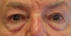 Before lower eyelid bag surgery(lower blepharoplasty)
